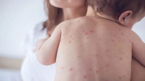 10 نصائح للأمهات في حال إصابة الابن بـ “بوحمرون”